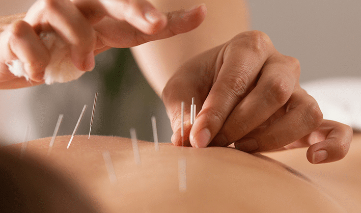 Acupuncture: What Can it Treat and What to Expect