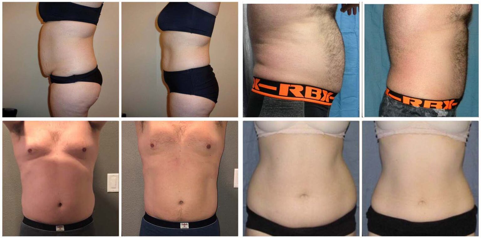 Zerona Body Contouring & Fat Loss Fountain Spa